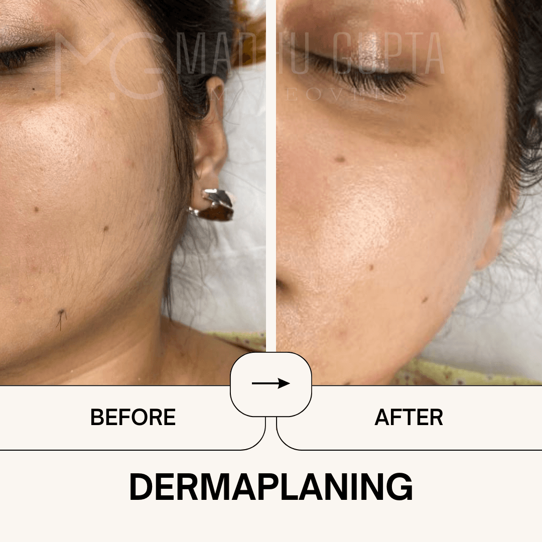 Dermaplanning Face Clean-Up