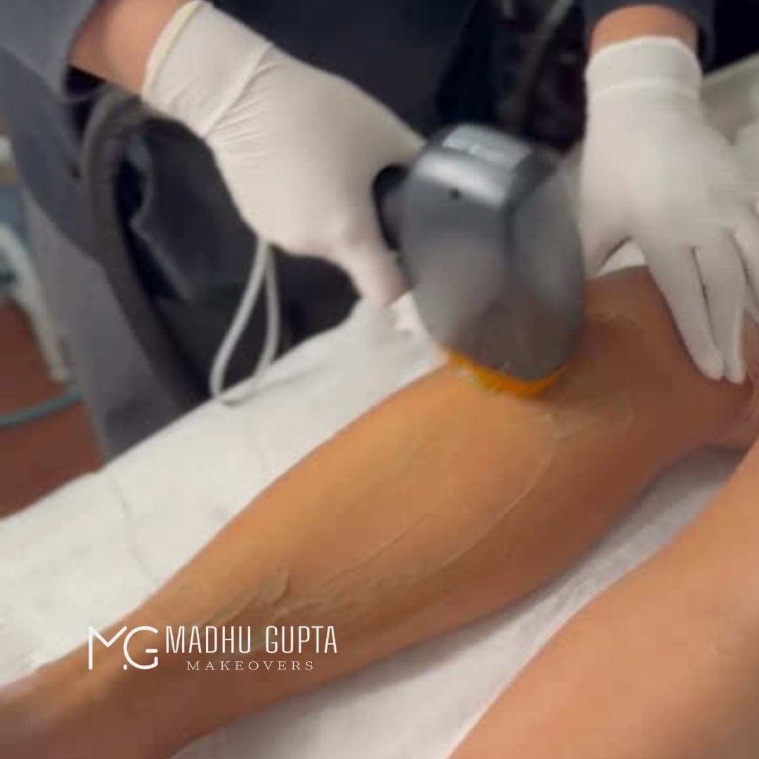 Laser Hair Removal