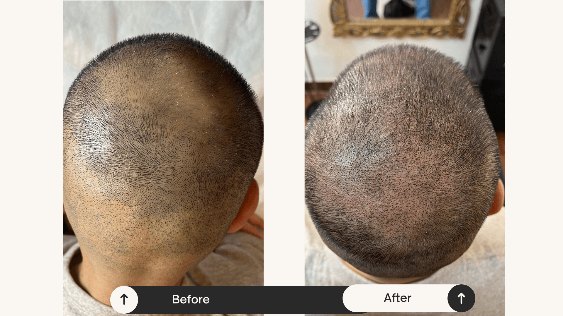 Scalp Micropigmentation