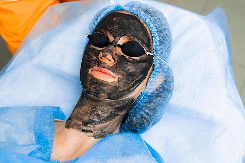 Carbon Facial At Mg Makeovers