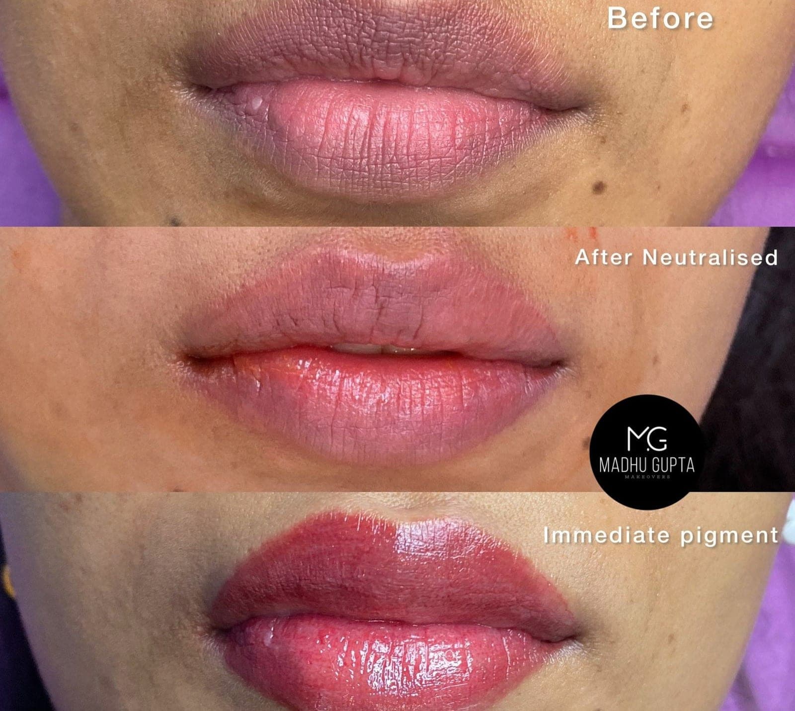 Lip neutralisation at MG Makeovers in three stages: before, after neutralisation and immediate pigment