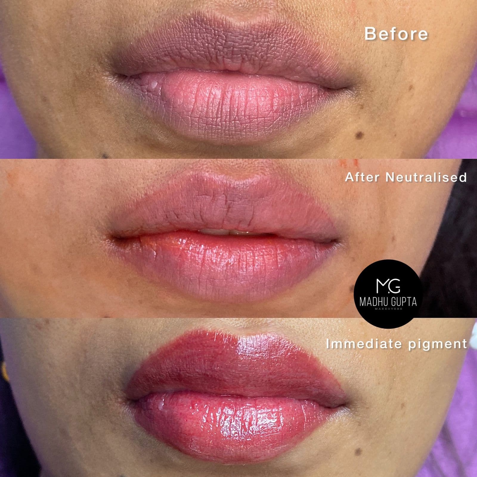 Lip Neutralization