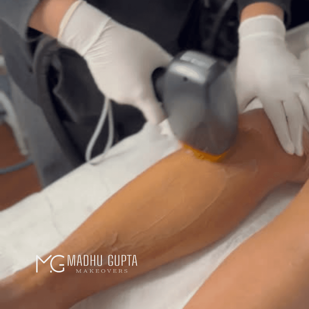 Laser Hair Removal