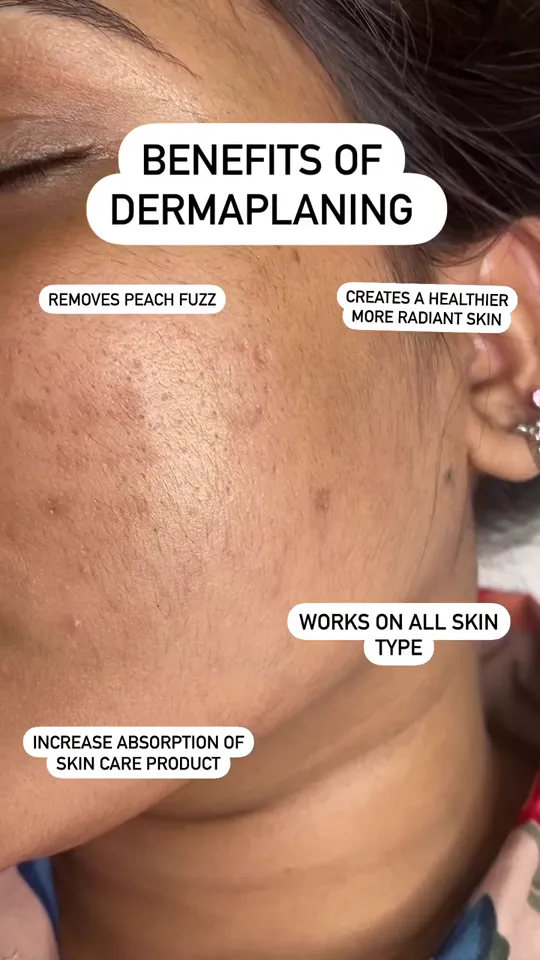 Why Dermaplaning